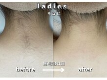 キュー(cue)/【レディース】「うなじ脱毛」