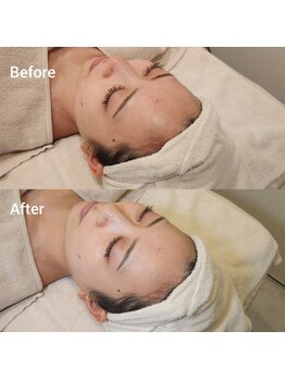 ジョイビー 新宿本店(JoyBee)/【白玉ピール】症例写真