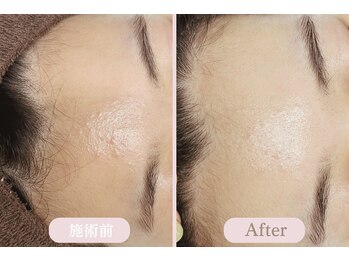 エピル(EPIL)/ララピール症例