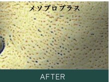 ダイヤモンド リーエンダ(Diamond leende)/メソプロプラス