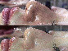 スノードロップ(snow drop)/毛穴洗浄