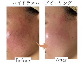 ベル(Belle)/ハイドラ+ハーブピーリング