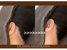 リリアーナ アサヒカワ(LILIANA ASAHIKAWA)/美肌光脱毛（うなじサイド）