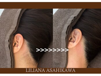 リリアーナ アサヒカワ(LILIANA ASAHIKAWA)/美肌光脱毛（うなじサイド）
