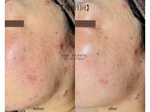 アン ビューティー(ann beauty)/施術1回【症例写真】30代