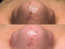 スリーナイン ビュウ(3Nine BEAU)/1回目before/after