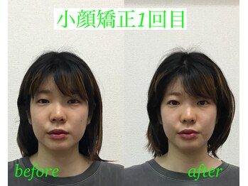 オズ六本木/小顔矯正モニター様@オズ六本木