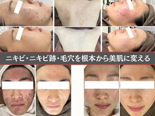 ニキビ研究所 千葉店
