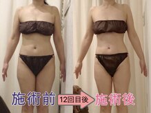 上野エステサロン レア(Lea)/【ハイパーナイフ正規取扱店】