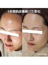 ビーピー 渋谷(b.p.)/ニキビケア　肌改善