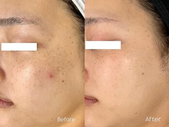 クク(ququ)/生まれつきのシミケアにも