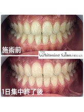 ホワイトニングサロン 京都烏丸店/ホワイトニング施術例