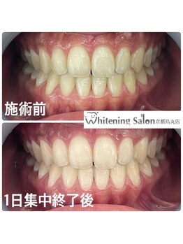 ホワイトニングサロン 京都烏丸店/ホワイトニング施術例