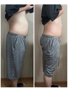 ルキア(LUKIA)/痩身【脂肪冷却】お腹集中３回目