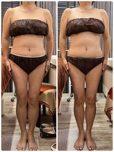 レヴィ(Revie)/60代ウルトラ造形リンパ1回