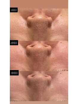 アレーズ(a l'aise)/毛穴ごっそり洗浄