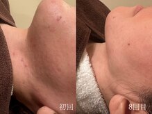 ウォーム(warm)/肌質改善/岡山/フェイシャル