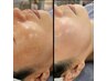 全てのトラブル修復ケア★韓国美容 ￥29,000