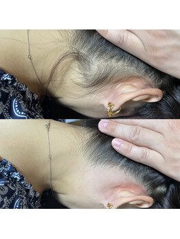 ティグレ 岡山店(TIGRE)/うなじWAX脱毛