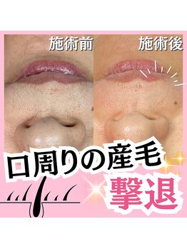 ホワイトワックス 名古屋金山店(WHITE WAX)/口周りの産毛も撃退