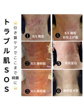 アネランスパ(Anelan Spa.)/トラブル肌の改善