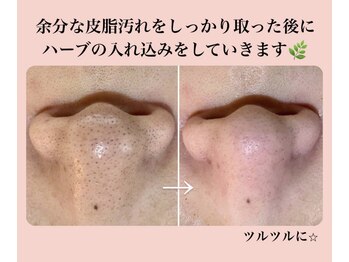 スキンハピネス(skinhappiness)/ハーブピーリング前/毛穴吸引