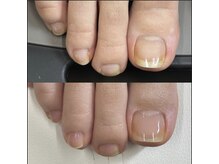 リリ(lili)/フットネイルスキンケア3回目