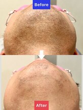 フィズ 明大前店(FIS)/ヒゲ脱毛