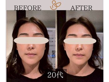 チョコバリ プラス(chocobari plus)/小顔×リフトアップ(美容)20代