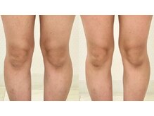 エキュロ 敦賀店(equro)/膝が小さくなり美脚に！