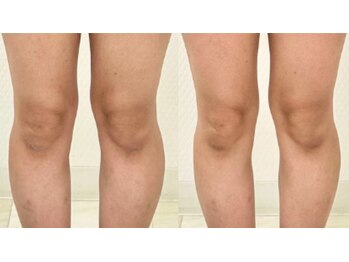エキュロ 敦賀店(equro)/膝が小さくなり美脚に！