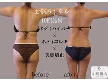 小顔職人/ボディビフォーアフター/30代