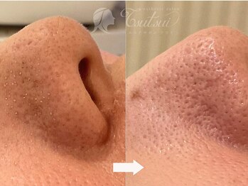 ツツイ/毛穴洗浄ピーリング症例