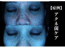 The水光美肌専科/ニキビケア