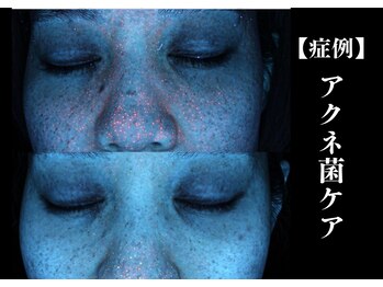 The水光美肌専科/ニキビケア