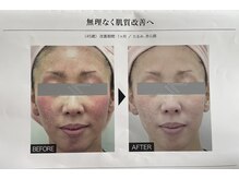 ビューティフィール アンド アリサナ(Beauty Feel&Arisana)/復元パックケアコース