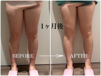 シフト 原宿店(SHIFT)/脂肪冷却 太もも