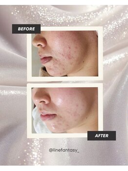 ラインファンタジー 武庫之荘店/角質ケアで肌のゴワつき解消！