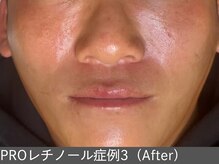 オアシスラグーン(OASIS LAGOON)/レチノール（症例3 after）