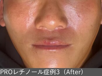 オアシスラグーン(OASIS LAGOON)/レチノール(症例3 after)