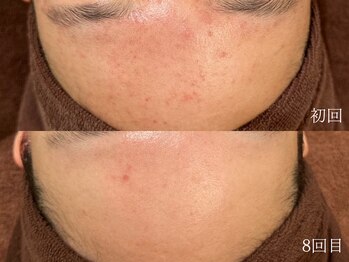 ウォーム(warm)/肌質改善/岡山/フェイシャル