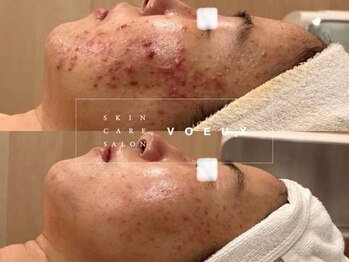 ボウ 名古屋店(VOEUX)の写真/その毛穴の黒ずみ、ニキビの始まりかも◎ニキビ専門13年の技術で黒ずみ・開き・ざらつき根本ケア
