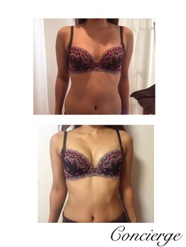 ルフルリール(Refleurir)/◆バストアップ症例/育乳◆