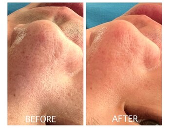 ケイナイン(K-9)/メンズ　ヒゲ脱毛＆毛穴ケア