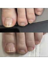 リリ(lili)/フットネイルスキンケア3回目