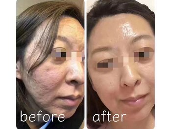 ココチ(KOKOCHI)/ダイヤモンドピール(6回)