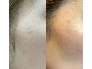 ココリール/シミ.黒ずみ