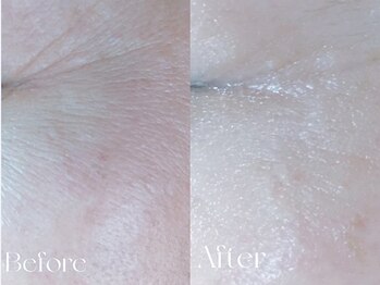 ウィハナ(wehana)/【セラピール】シワ/たるみ