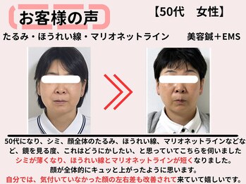 サロンスマイル/50代美容鍼ビフォーアフター