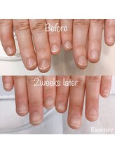 エッセンス (Essence)/お悩み改善◎深爪改善コース